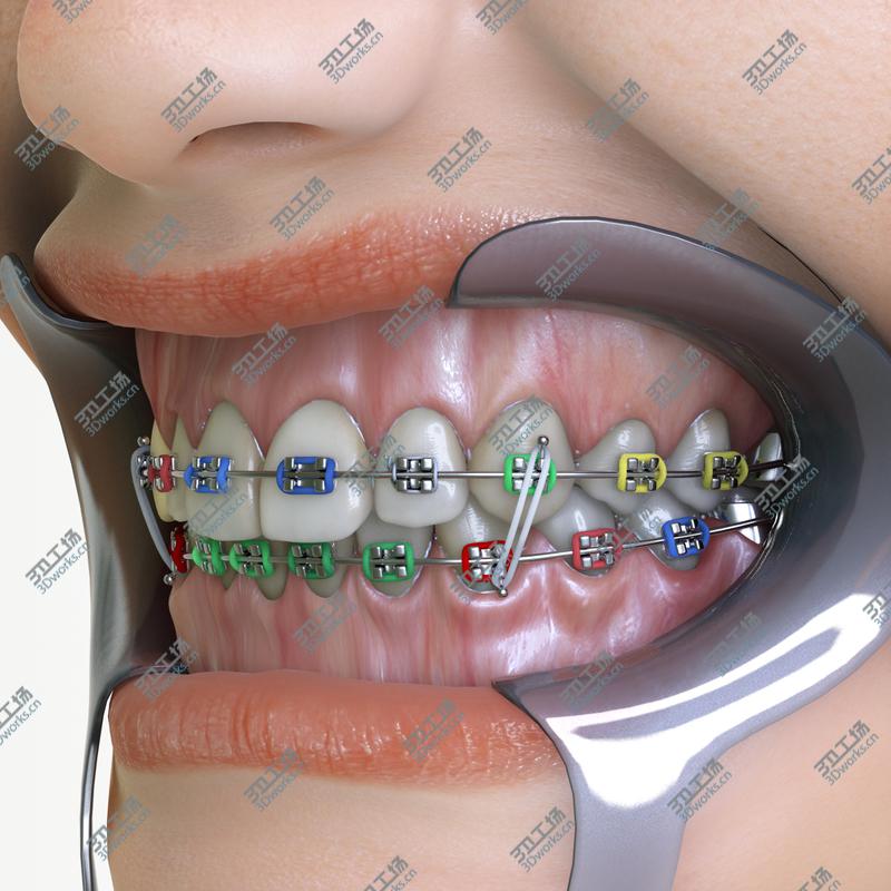 images/goods_img/202104091/Orthodontic Mouth/4.jpg